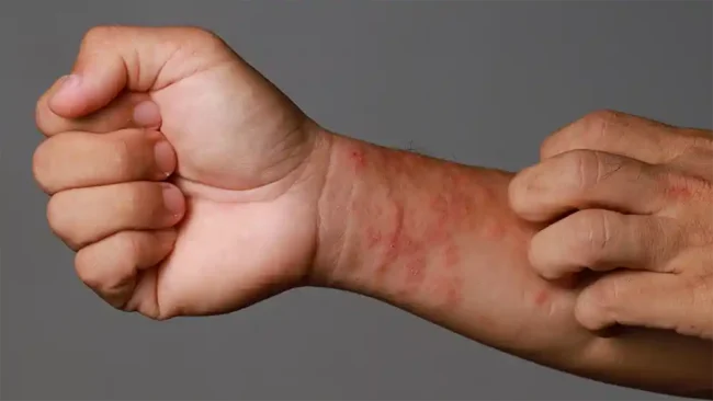 blog10 eczema